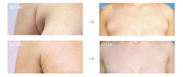 副乳切除还会复发吗有哪些适应范围