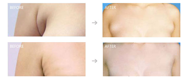 副乳切除还会复发吗有哪些适应范围 副乳切除还会复发吗有哪些适应范围