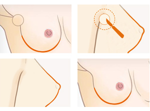 副乳切除注意哪些细节 副乳切除注意哪些细节