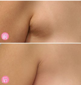 副乳吸脂整形术的手术过程