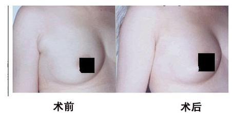 副乳切除手术前应注意什么 副乳切除手术前应注意什么