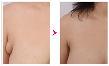 副乳切除手术是怎么进行的 副乳切除手术是怎么进行的