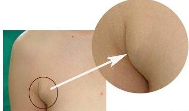 副乳吸脂术禁忌人群