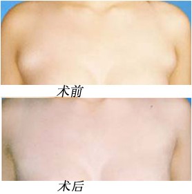 副乳切除手术的适应范围及手术价格