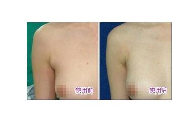 副乳切除手术的切口选择及注意事项 副乳切除手术的切口选择及注意事项