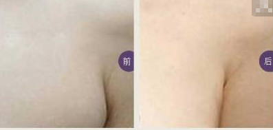 副乳吸脂的价格