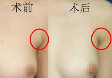 副乳切除手术的过程及恢复时间 副乳切除手术的过程及恢复时间