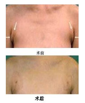 副乳切除手术费用影响因素 副乳切除手术费用影响因素