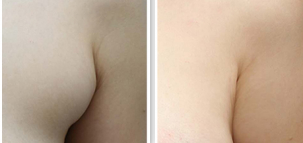 副乳切除手术具体步骤