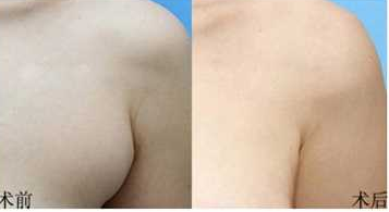 副乳切除术的副作用有哪些 副乳切除术的副作用有哪些