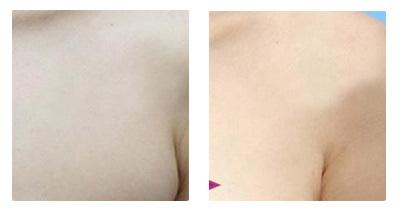 副乳切除术的过程,手术切口怎么选 副乳切除术的过程,手术切口怎么选