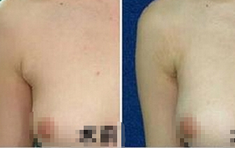 副乳切除术的后遗症,伤口感染怎么办