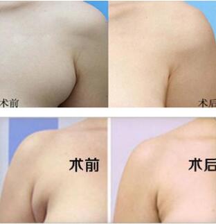 副乳切除术前准备 副乳切除术前准备