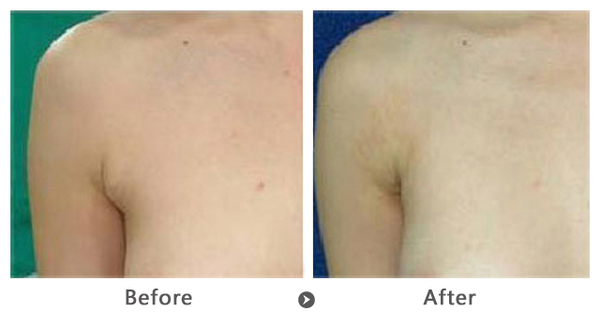 副乳切除术的几种方法 副乳切除术的几种方法