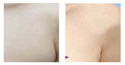 副乳切除术的适应范围及价格 副乳切除术的适应范围及价格