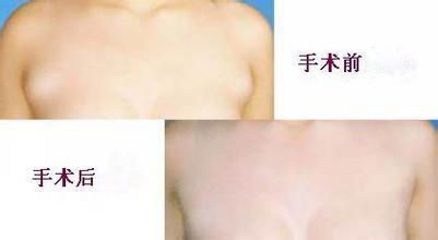 副乳切除术的优点及复发率 副乳切除术的优点及复发率