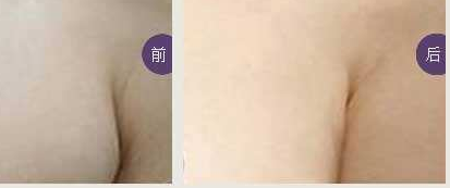 副乳切除术的优势 副乳切除术的优势