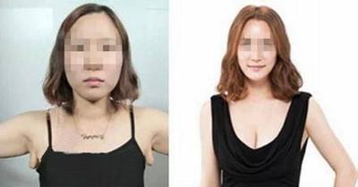 抽脂副乳休息多久恢复 抽脂副乳休息多久恢复