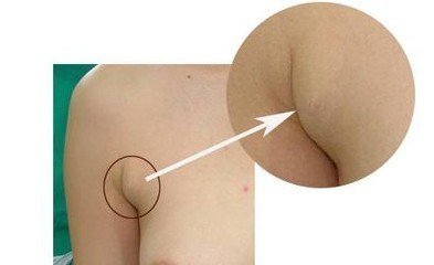 做副乳手术需要多少钱 做副乳手术需要多少钱