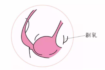 做副乳切除手术什么时候最适合 做副乳切除手术什么时候最适合