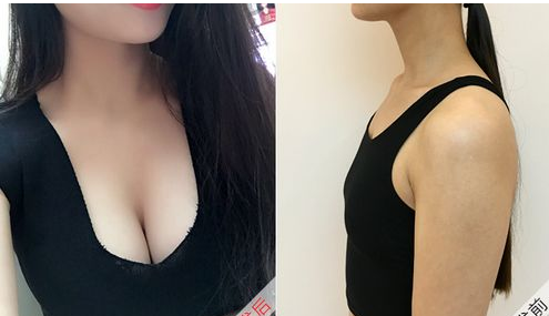隆胸前后效果对比照片