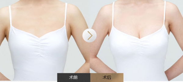 有什么丰胸的好办法