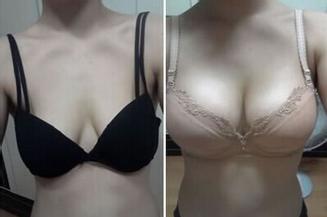 隆胸手术过程会不会很痛