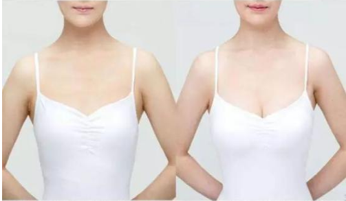北京妙桃假体隆胸效果好吗