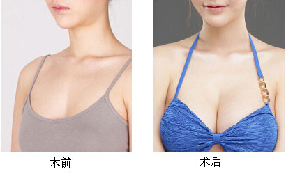 河南自体脂脂肪隆胸的优势有哪些