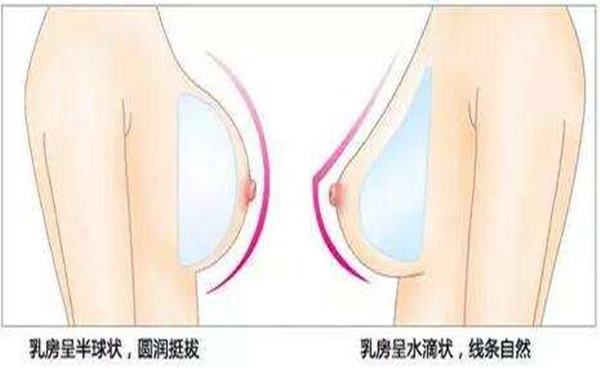 妙桃晴面假体隆胸的4大特点 妙桃晴面假体隆胸的4大特点