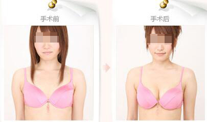 假体隆胸术后乳房有点肿怎么回事