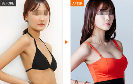 假体隆胸术后乳房变硬怎么办