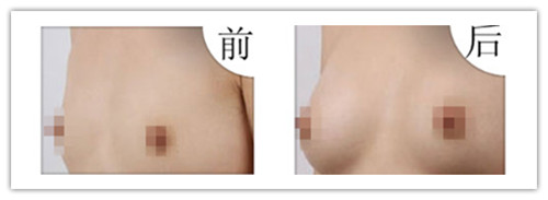 假体隆胸手术有什么特点