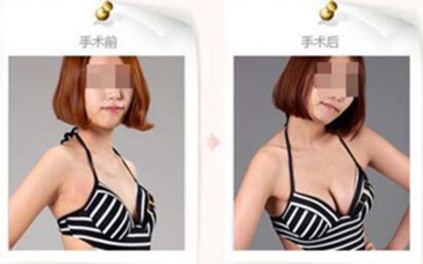隆胸手术失败后有哪些修复方法