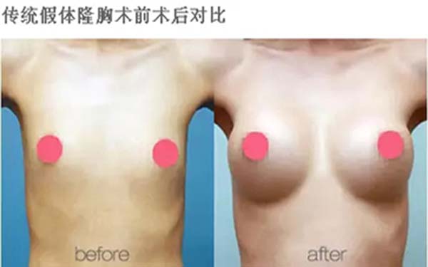 假体隆胸后胸部为什么不软