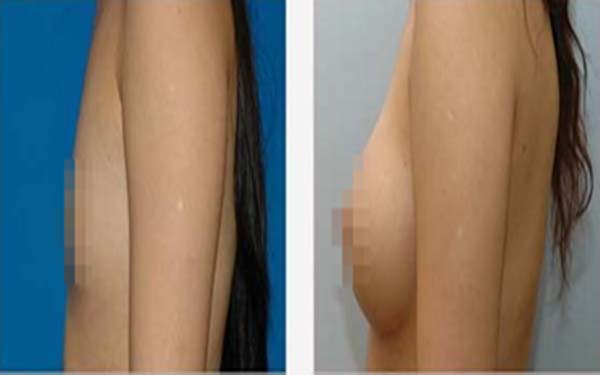 脂肪填充胸多久能存活 脂肪填充胸多久能存活