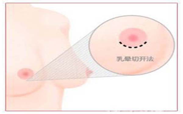 假体隆胸后该如何按摩呢