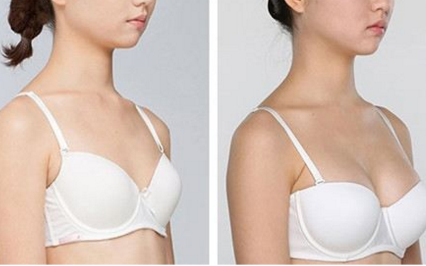 奥美定隆胸失败后能完全取出