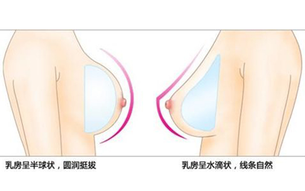 娜绮丽圆形假体价格 娜绮丽圆形假体价格