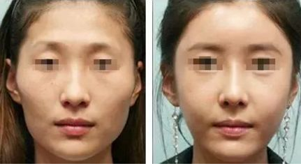 桂林脸部凹陷治疗大概需要多少费用 桂林脸部凹陷治疗大概需要多少费用