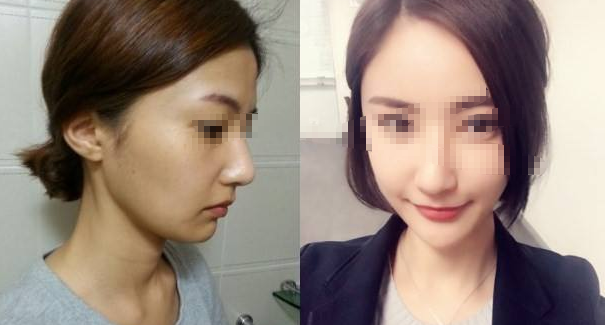 脂肪填充全脸多久自然 脂肪填充全脸多久自然