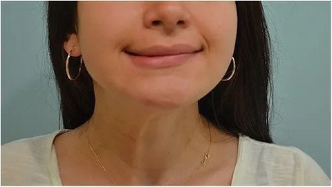 歪嘴怎么治疗好 歪嘴怎么治疗好