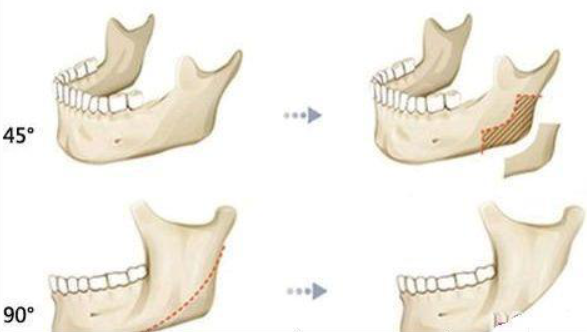 劈外板是什么 劈外板是什么