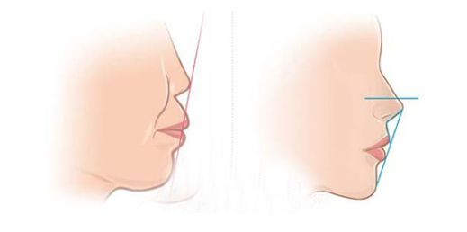 骨性嘴凸怎么矫正
