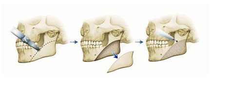 下额骨可以整形吗 下额骨可以整形吗