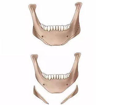 下颌削骨手术价格