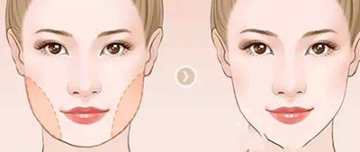 额骨突出能怎样改善 额骨突出能怎样改善