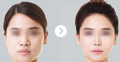 颌面整形手术的方法有哪些? 颌面整形手术的方法有哪些?