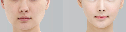 做下额角整形安全性有哪些呢 做下额角整形安全性有哪些呢