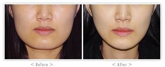 下额角整形安全性有哪些呢 下额角整形安全性有哪些呢